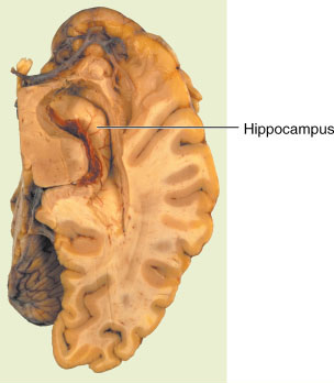Повреждение гиппокампа. Гиппокамп анатомия. Гиппокамп анатомия препарат. Гиппокамп на препарате мозга. Hippocampus на препарате.